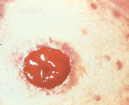 Folliculitis