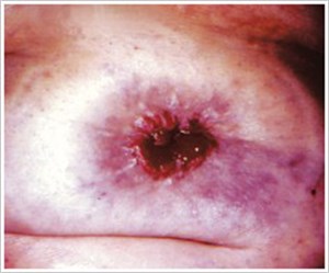 Caput Medusae