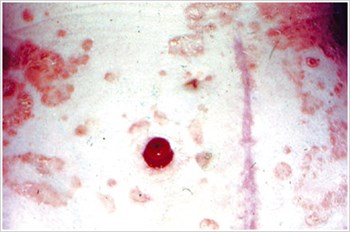 Psoriasis